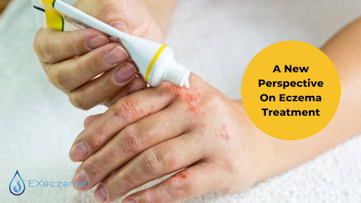 A New Perspective On Eczema Treatment