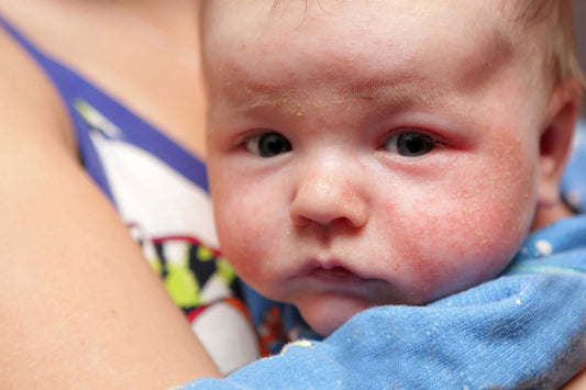 Atopic Eczema