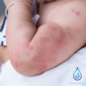 The EXeczema® Referral Program