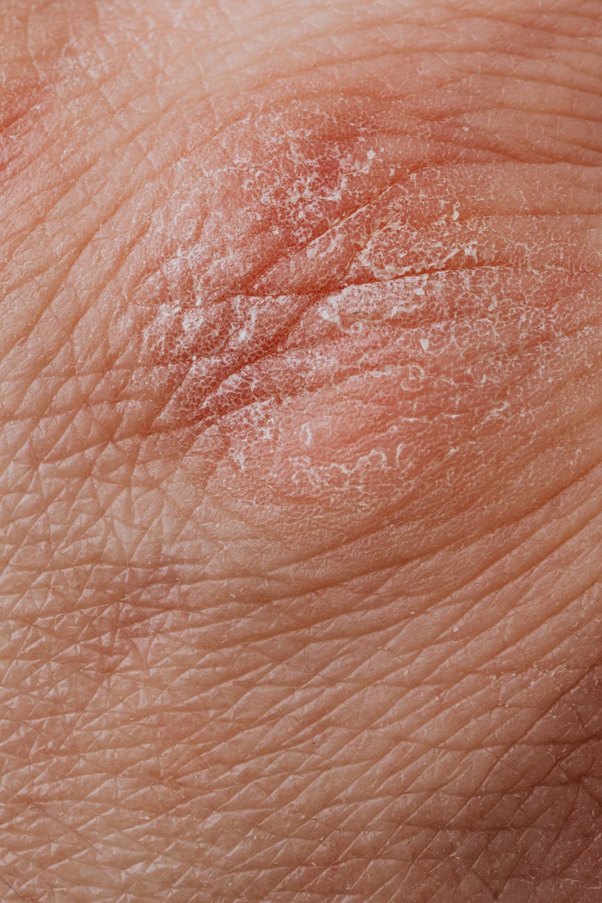  Why Don’t Eczema Creams Work