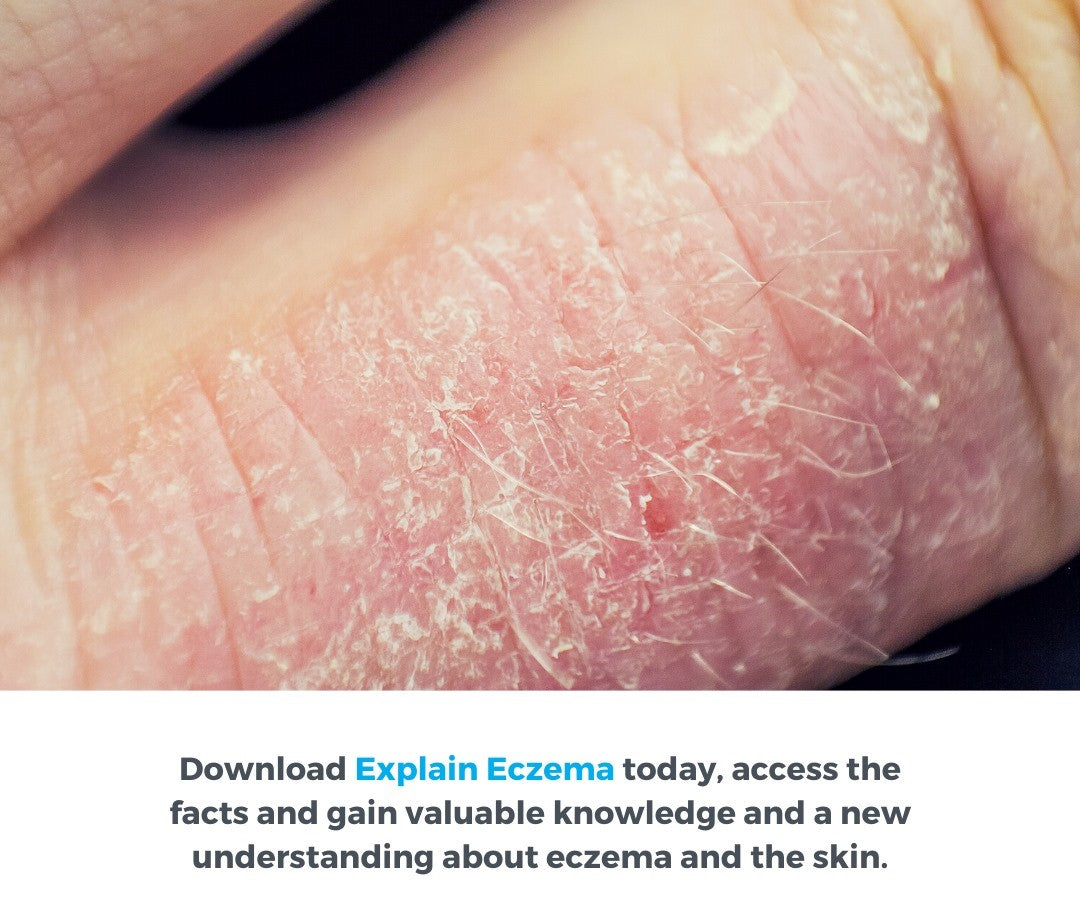 Execzema The Eczema Trap – EXeczema UK
